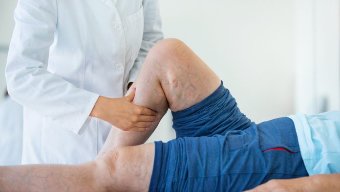 Varicose Vein Treatment Within Easy Reach